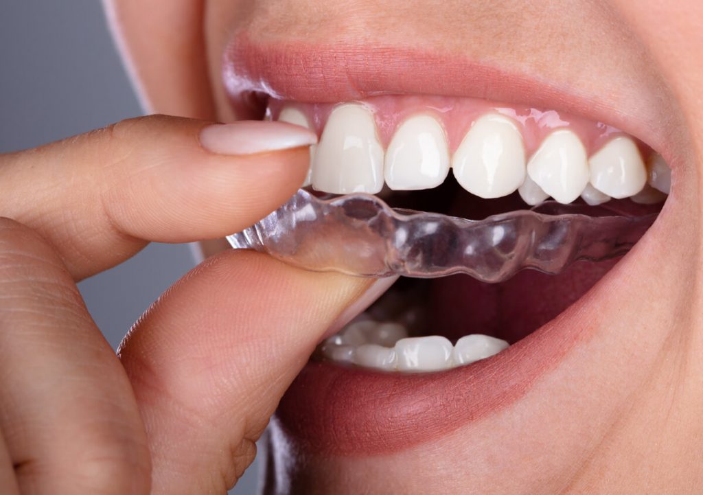 Adult Orthodontics with Invisalign Knoxville TN