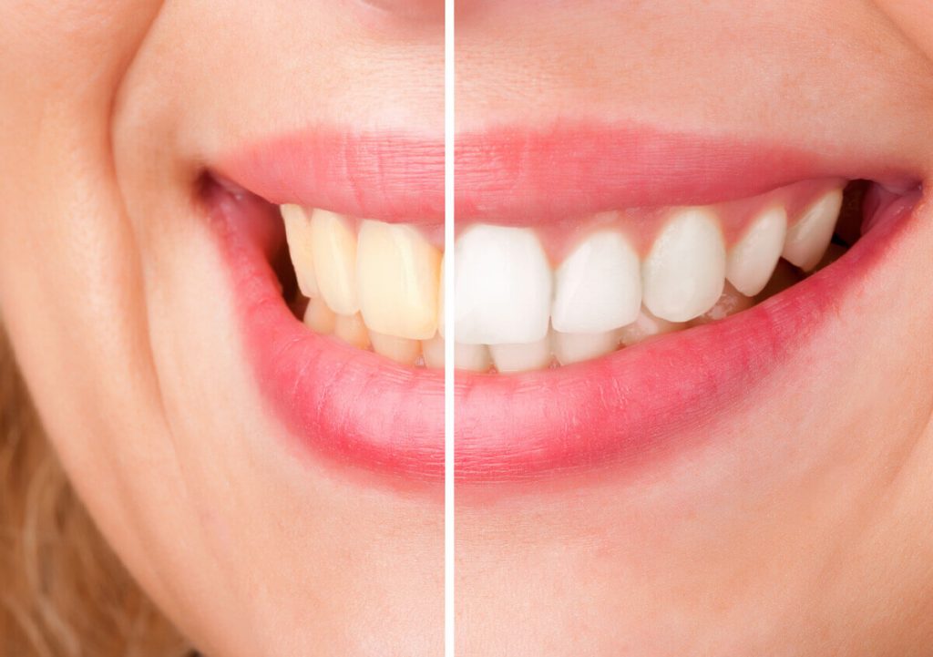 Teeth Whitening Knoxville TN