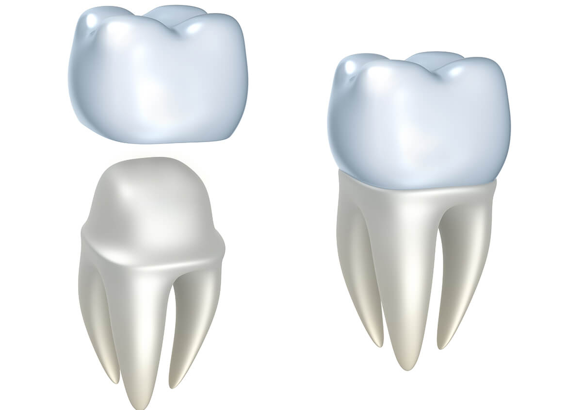 Dental Crowns in Knoxville TN Area