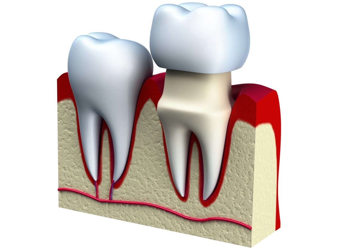 Benefits Of Affordable Dental Crowns Near Me in Knoxville TN Area