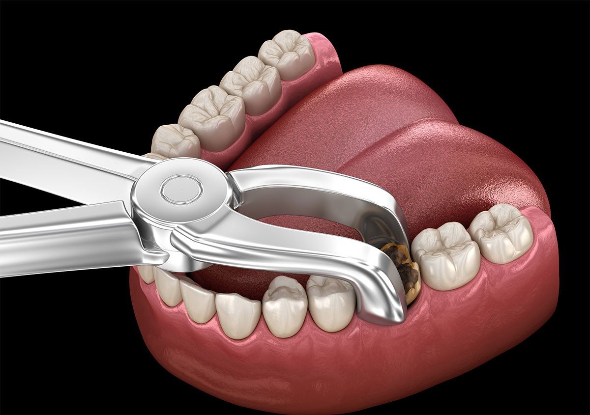 Getting a Tooth Removed in Knoxville TN Area