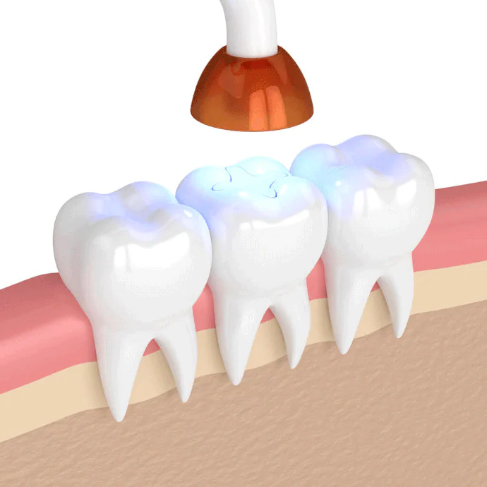 Dental Fillings & Sealants