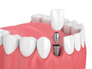 Dental Implants candidacy in Knoxville, TN, at South Knox Dental
