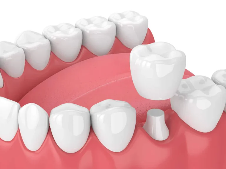 How to care for your dental crown