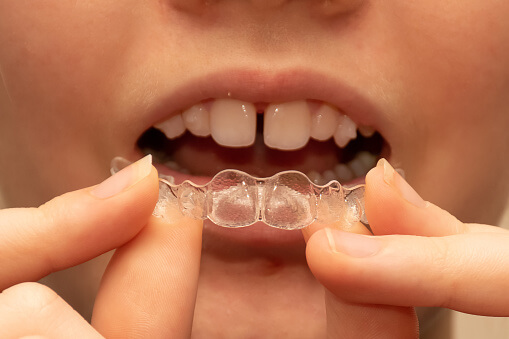 clear aligners dental services at south knox dental in southlake tx