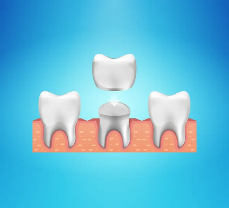 dental crown illustration